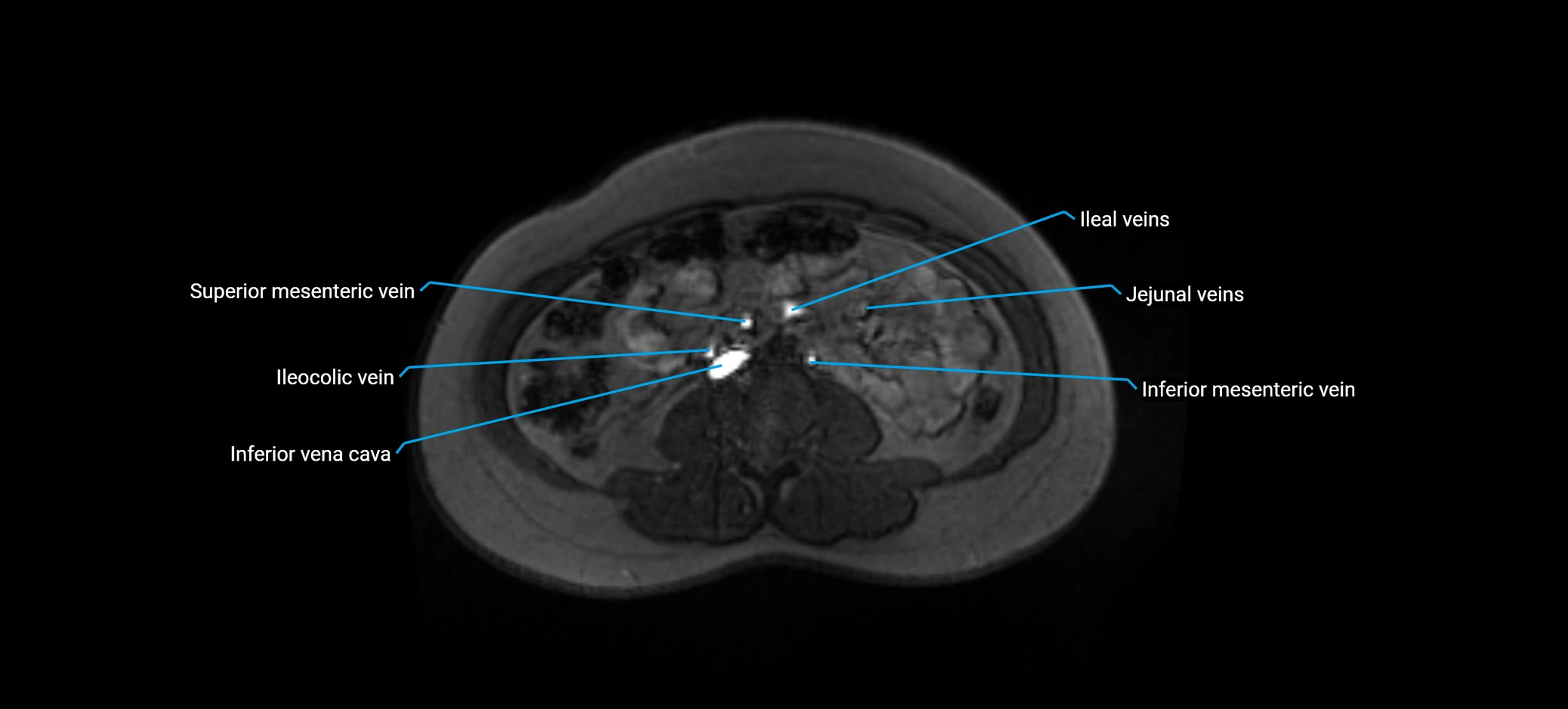 MRV abdomen pelvis & lower limb axial cross sectional anatomy labelled MRI image 98 (1).webp